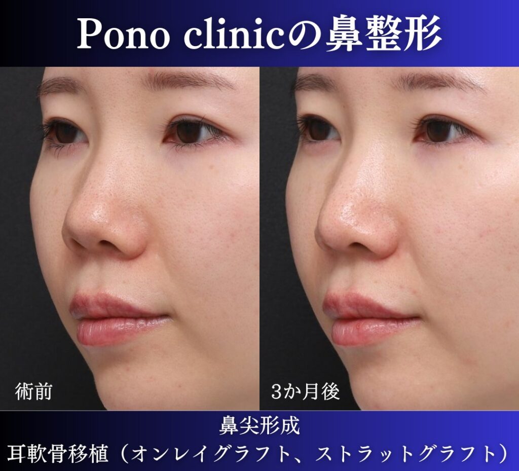 鼻尖形成、軟骨移植の症例 (4)