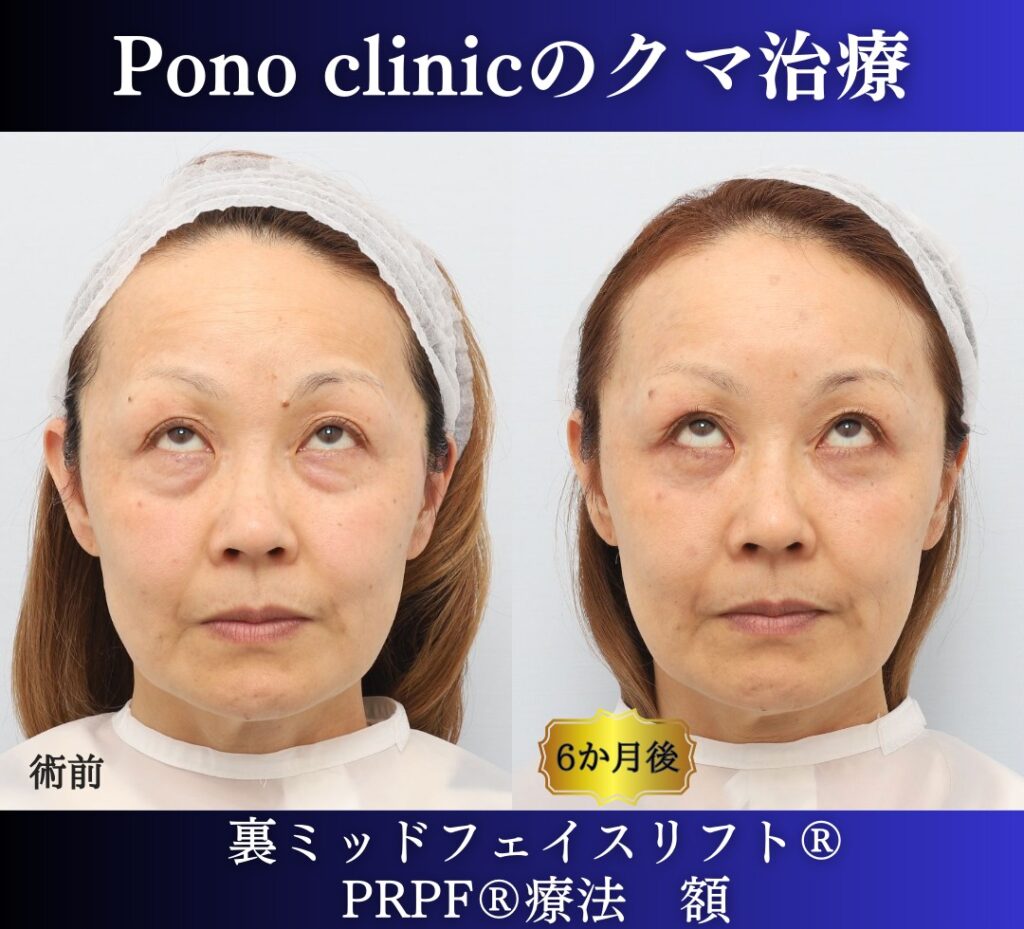 50代女性、目の下のたるみ取りの治療、裏ミッドフェイスリフト (10)