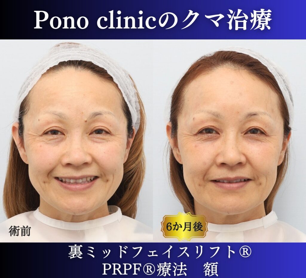 50代女性、目の下のたるみ取りの治療、裏ミッドフェイスリフト (11)