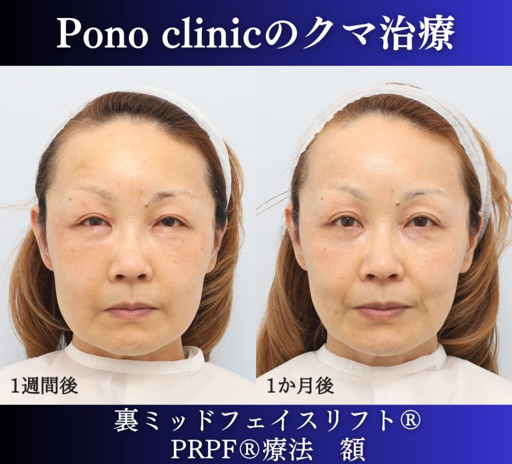 50代女性、目の下のたるみ取りの治療、裏ミッドフェイスリフト (7)