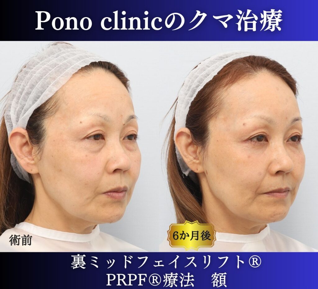 50代女性、目の下のたるみ取りの治療、裏ミッドフェイスリフト (8)