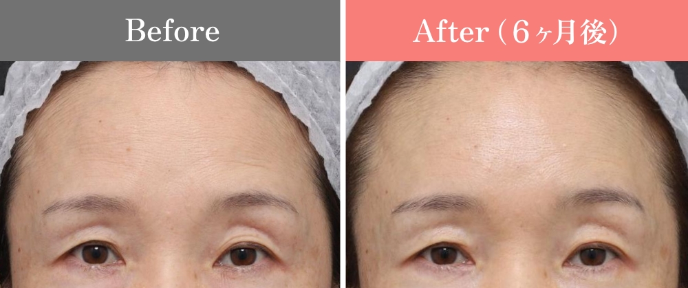 おでこ しわ 女性