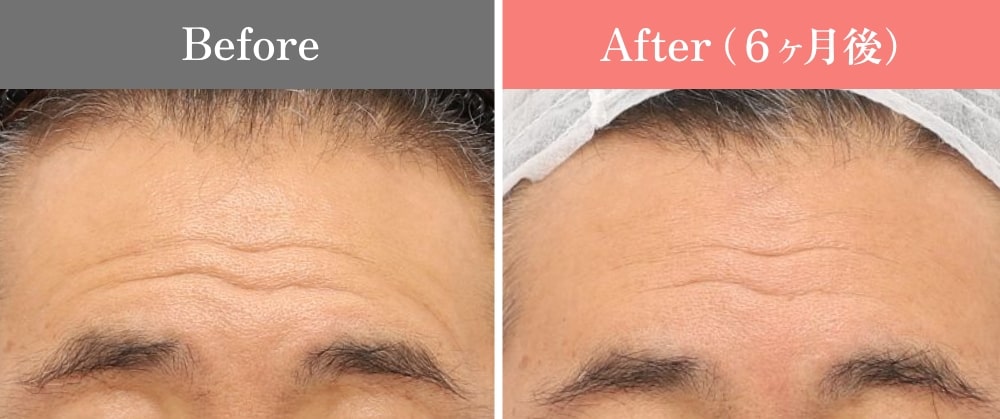 おでこしわ 男性