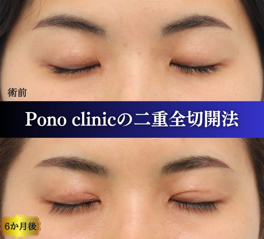二重整形、二重全切開法、上まぶたのたるみ取り30代女性の症例 (6)