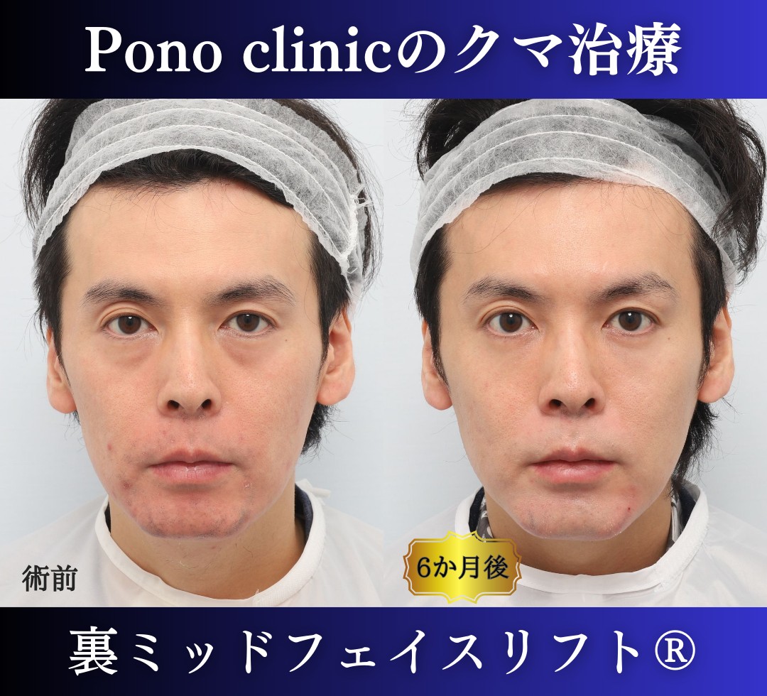 30代男性、クマ取り、裏ハムラの症例 (1)