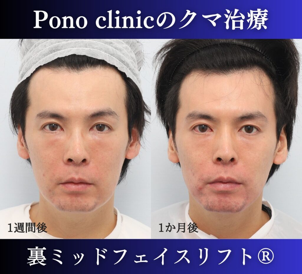 30代男性、クマ取り、裏ハムラの症例 (2)