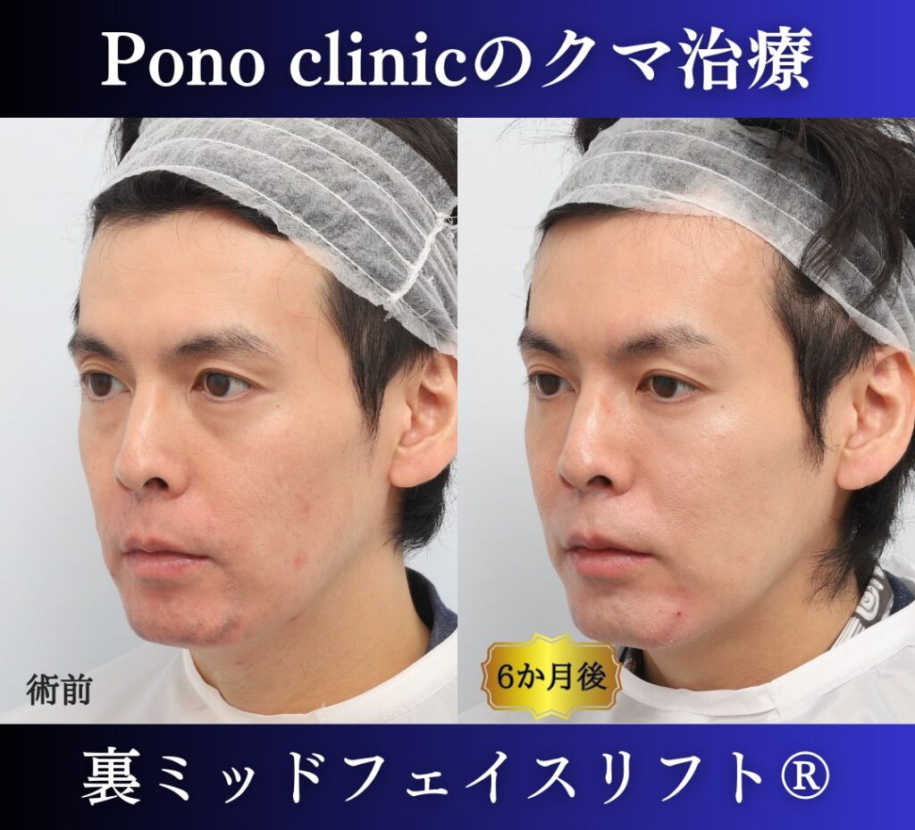 30代男性、クマ取り、裏ハムラの症例 (4)