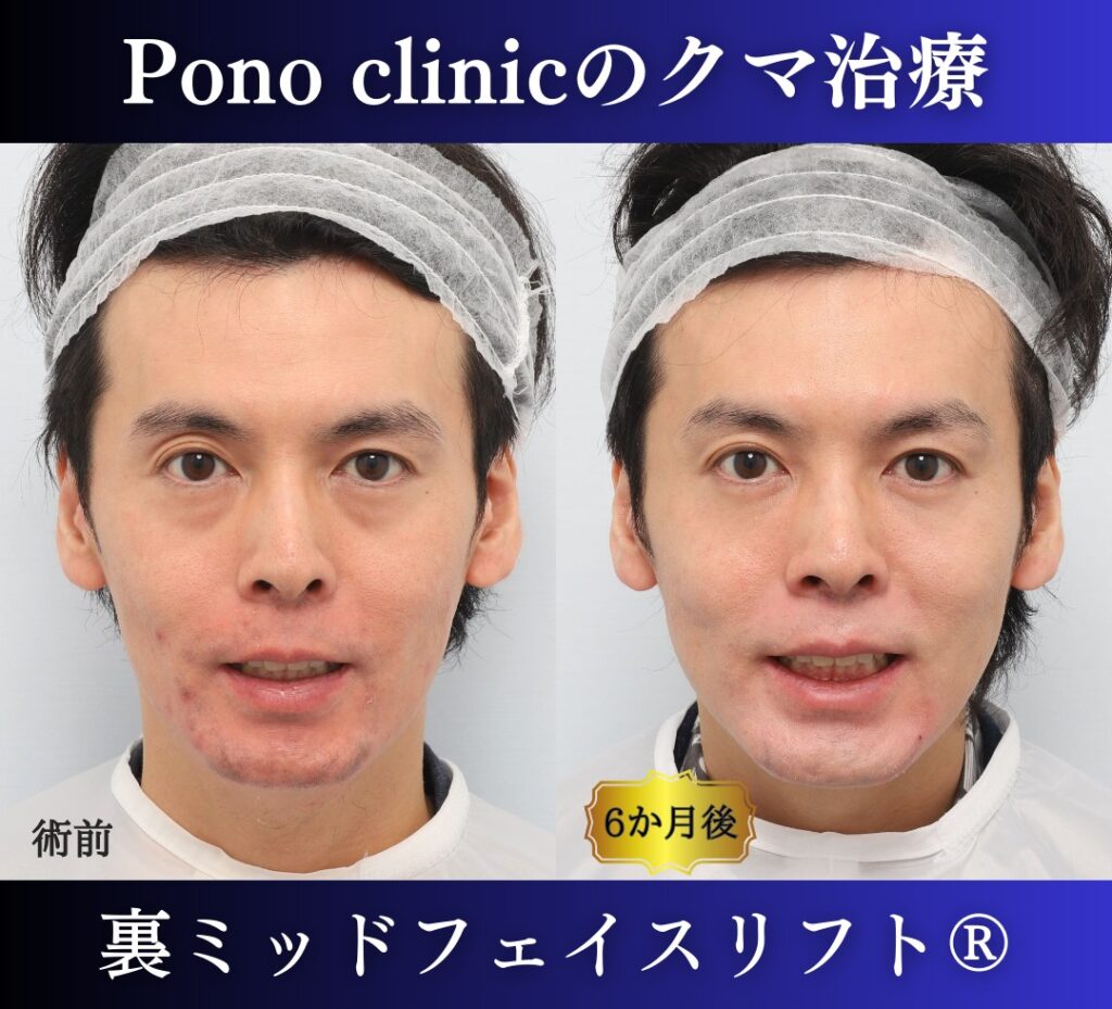 30代男性、クマ取り、裏ハムラの症例 (5)