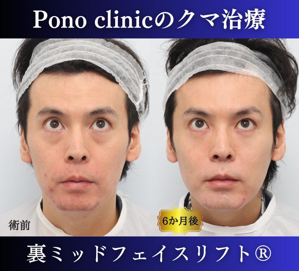 30代男性、クマ取り、裏ハムラの症例 (6)