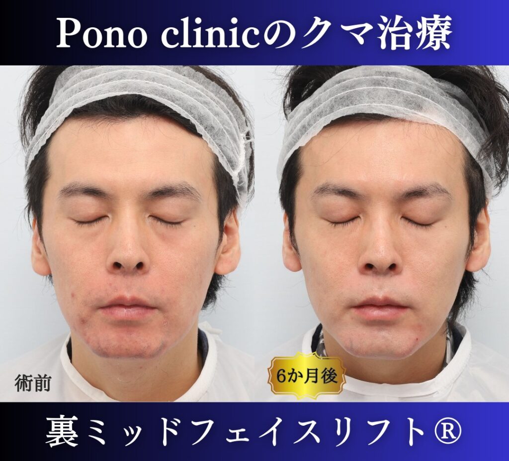 30代男性、クマ取り、裏ハムラの症例 (7)