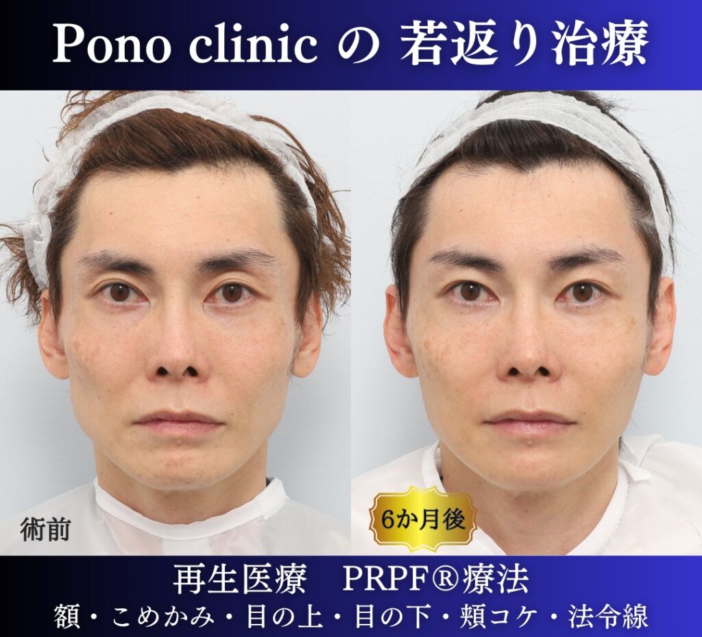 40代男性の症例、アンチエイジング治療、PRPF療法 (2)