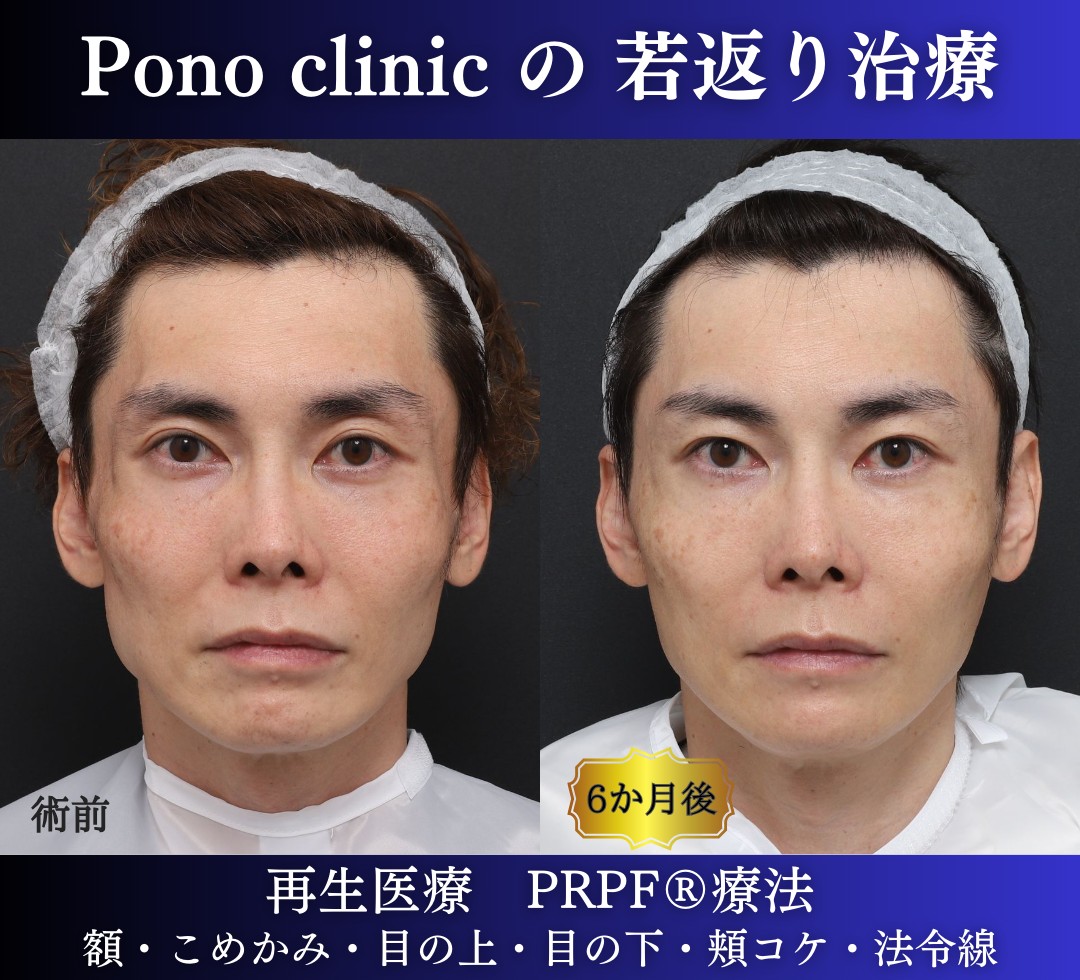 40代男性の症例、アンチエイジング治療、PRPF療法 (7)