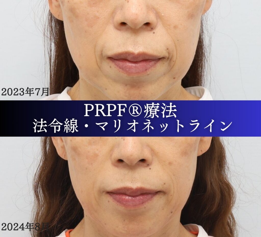 しわ取り、PRPF 療法、法令線、マリオネットライン、60代女性の症例 (2)