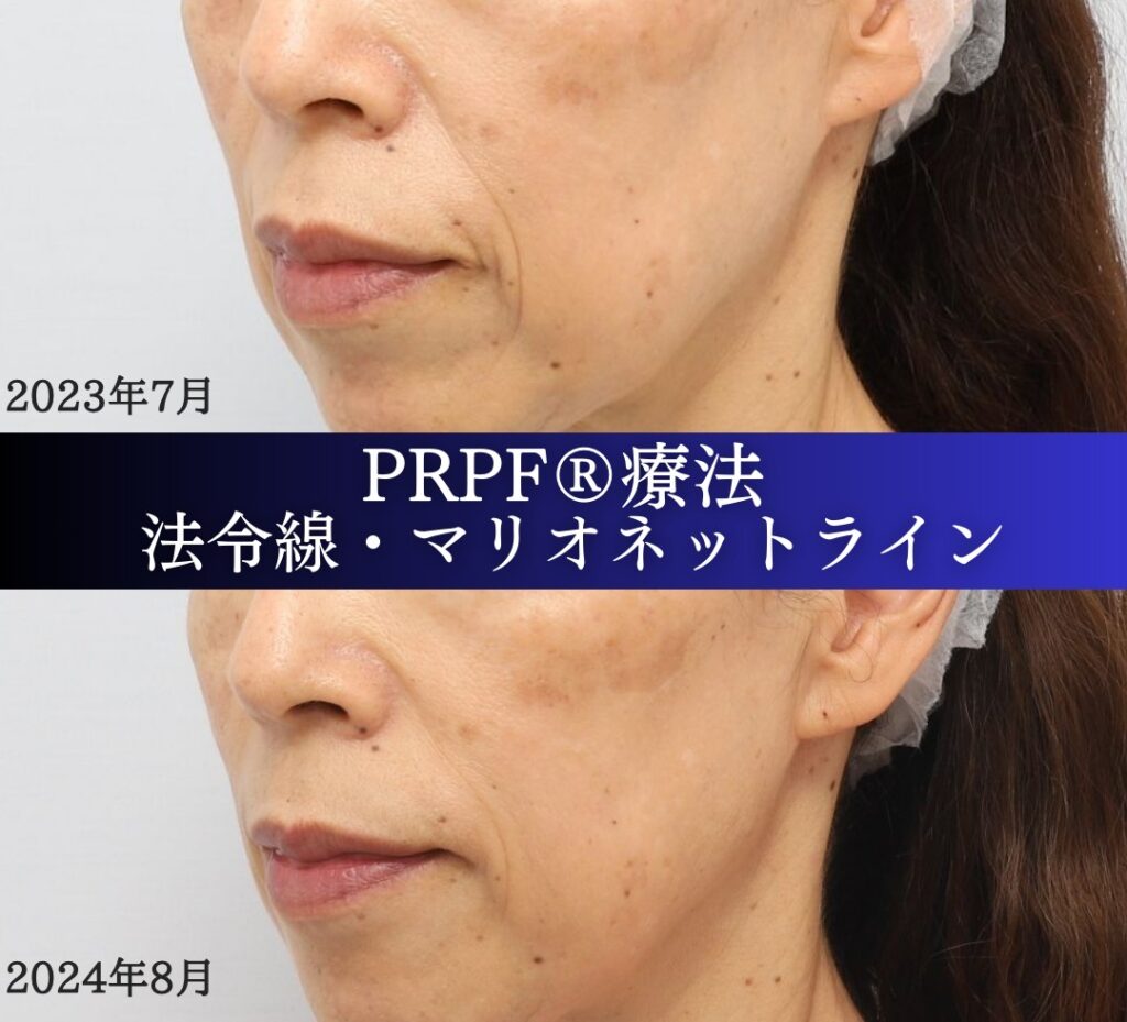 しわ取り、PRPF 療法、法令線、マリオネットライン、60代女性の症例 (3)