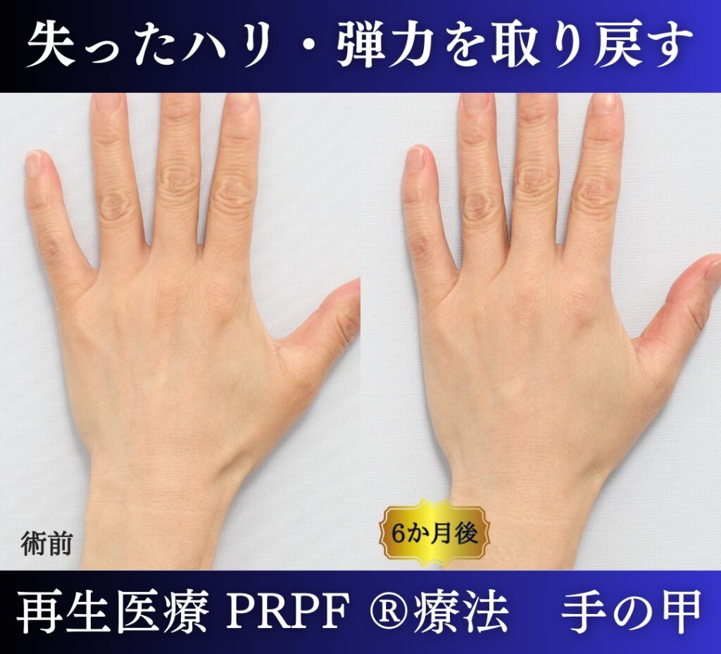 手の甲、若返り治療、PRPF 療法 (1)