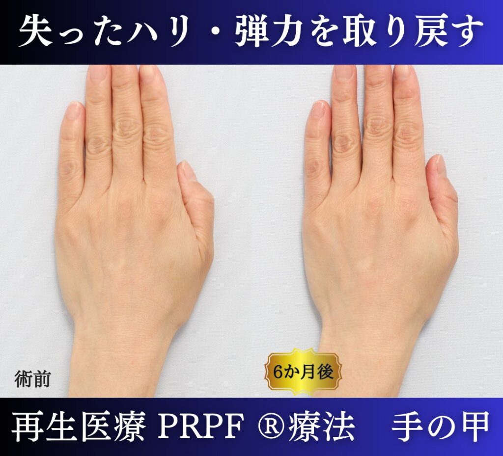 手の甲、若返り治療、PRPF 療法 (2)