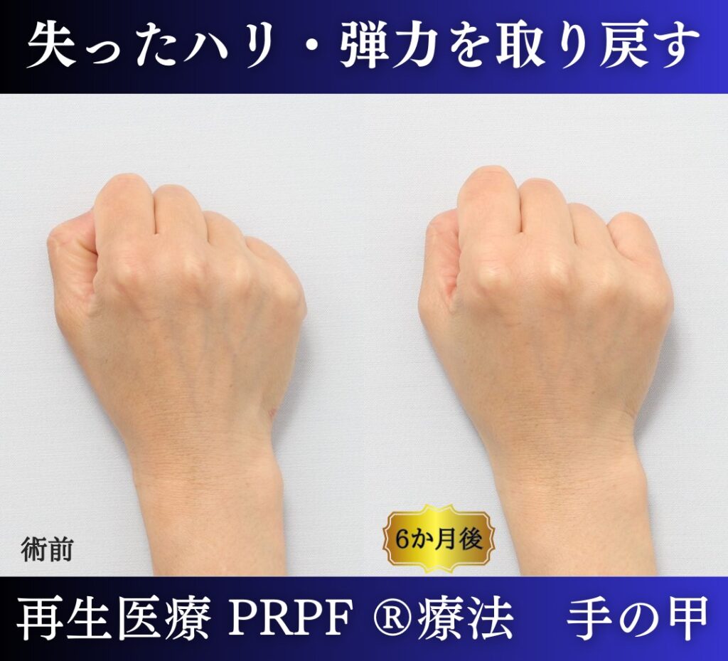 手の甲、若返り治療、PRPF 療法 (4)