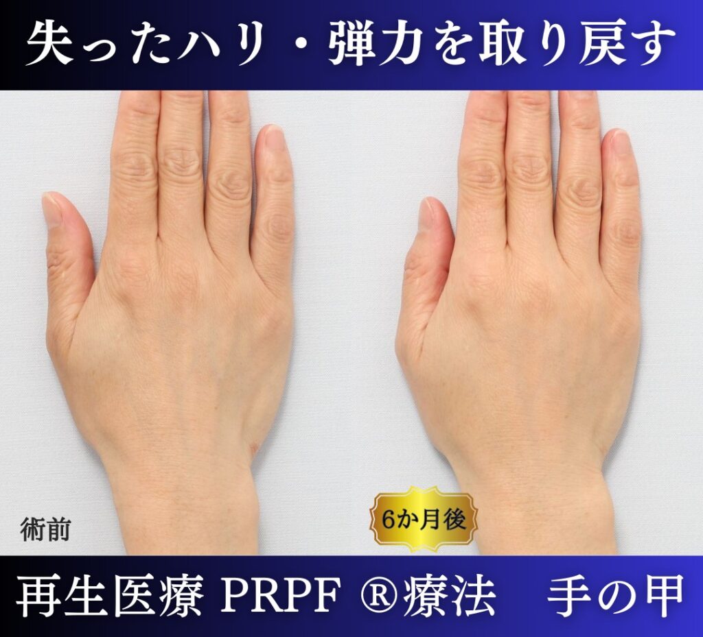 手の甲、若返り治療、PRPF 療法 (6)