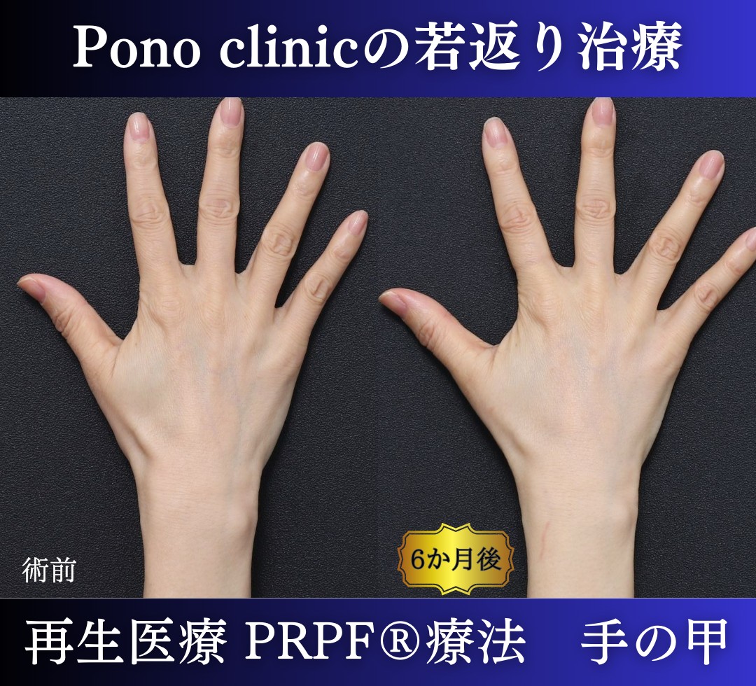手の甲のアンチエイジング、PRPF療法、50代の症例 (1)