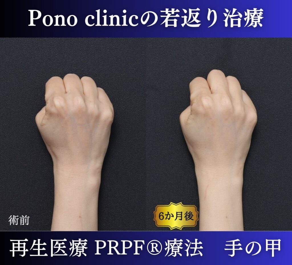 手の甲のアンチエイジング、PRPF療法、50代の症例 (5)