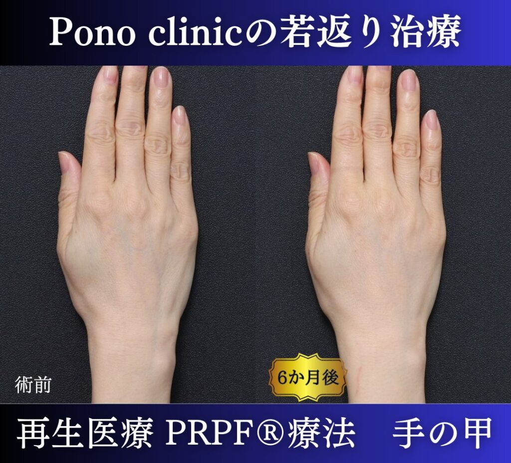 手の甲のアンチエイジング、PRPF療法、50代の症例 (6)