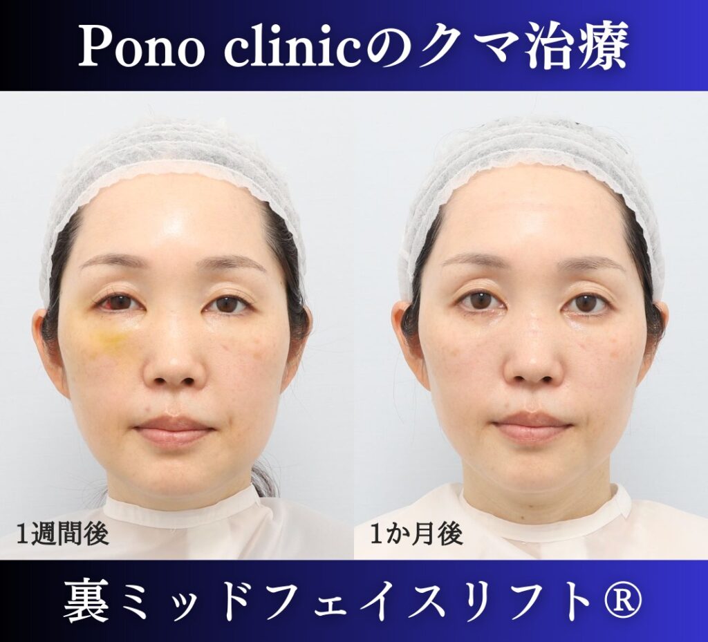 目の下のクマ取り、裏ハムラ、40代女性の症例 (1)