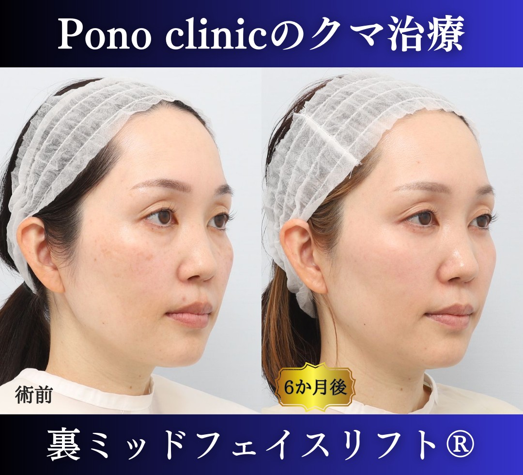 目の下のクマ取り、裏ハムラ、40代女性の症例 (2)