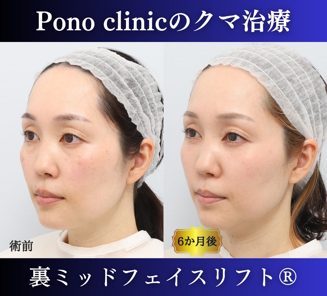 目の下のクマ取り、裏ハムラ、40代女性の症例 (3)