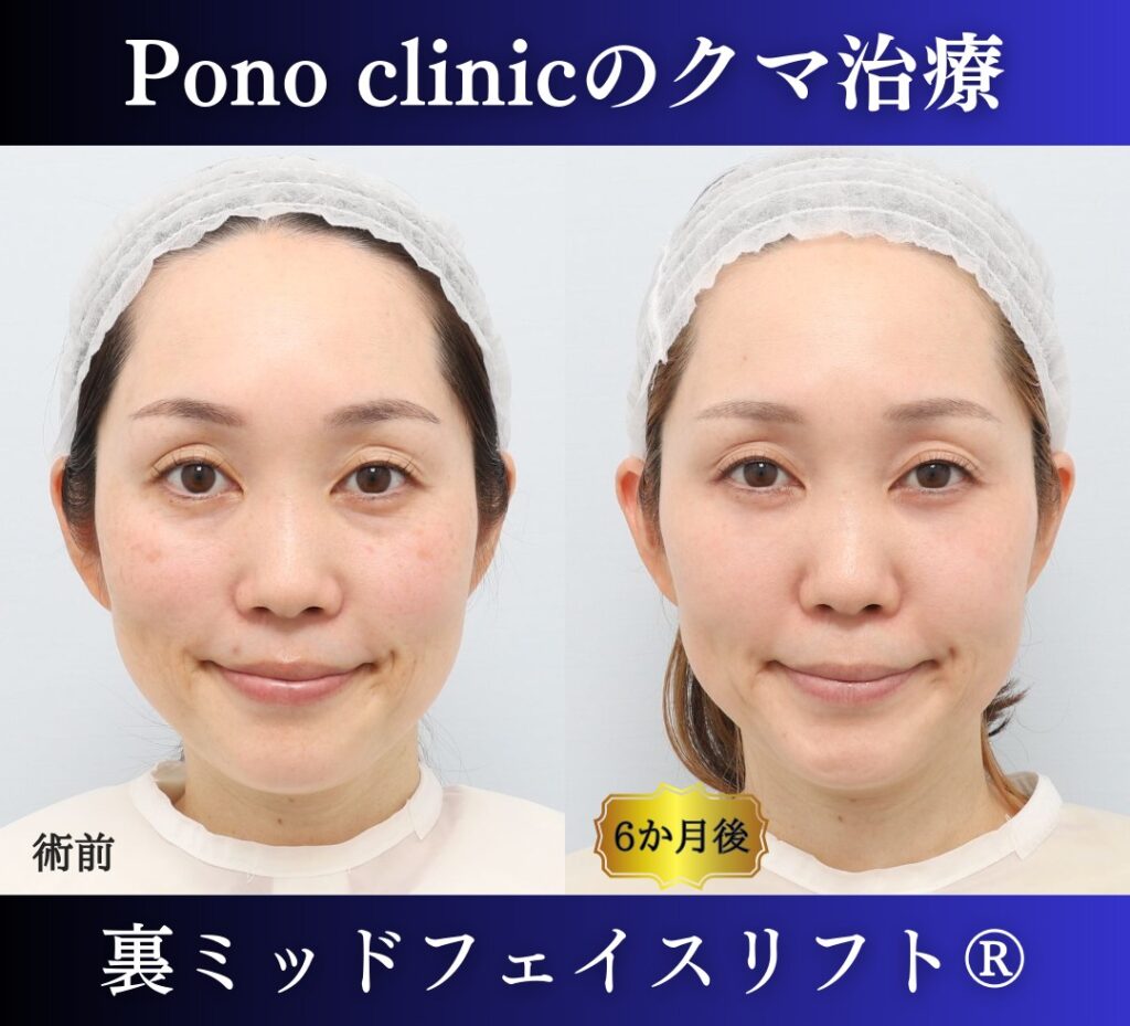 目の下のクマ取り、裏ハムラ、40代女性の症例 (4)