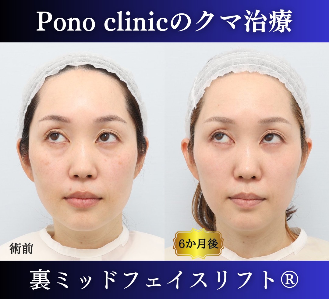 目の下のクマ取り、裏ハムラ、40代女性の症例 (5)