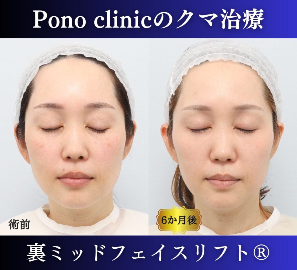 目の下のクマ取り、裏ハムラ、40代女性の症例 (6)