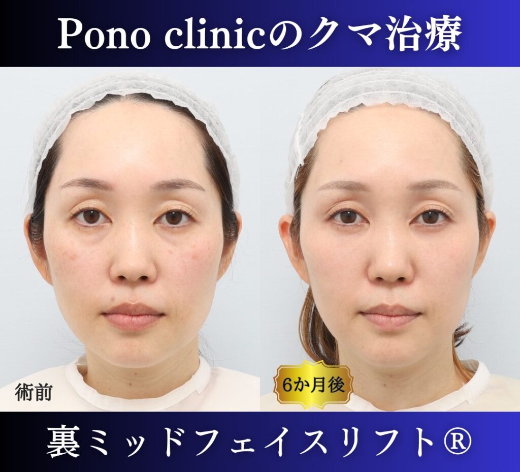 目の下のクマ取り、裏ハムラ、40代女性の症例 (7)