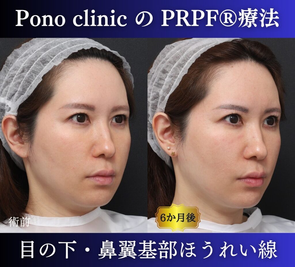 青クマ、法令線、鼻翼基部の凹み、PRPF®療法の症例 (1)