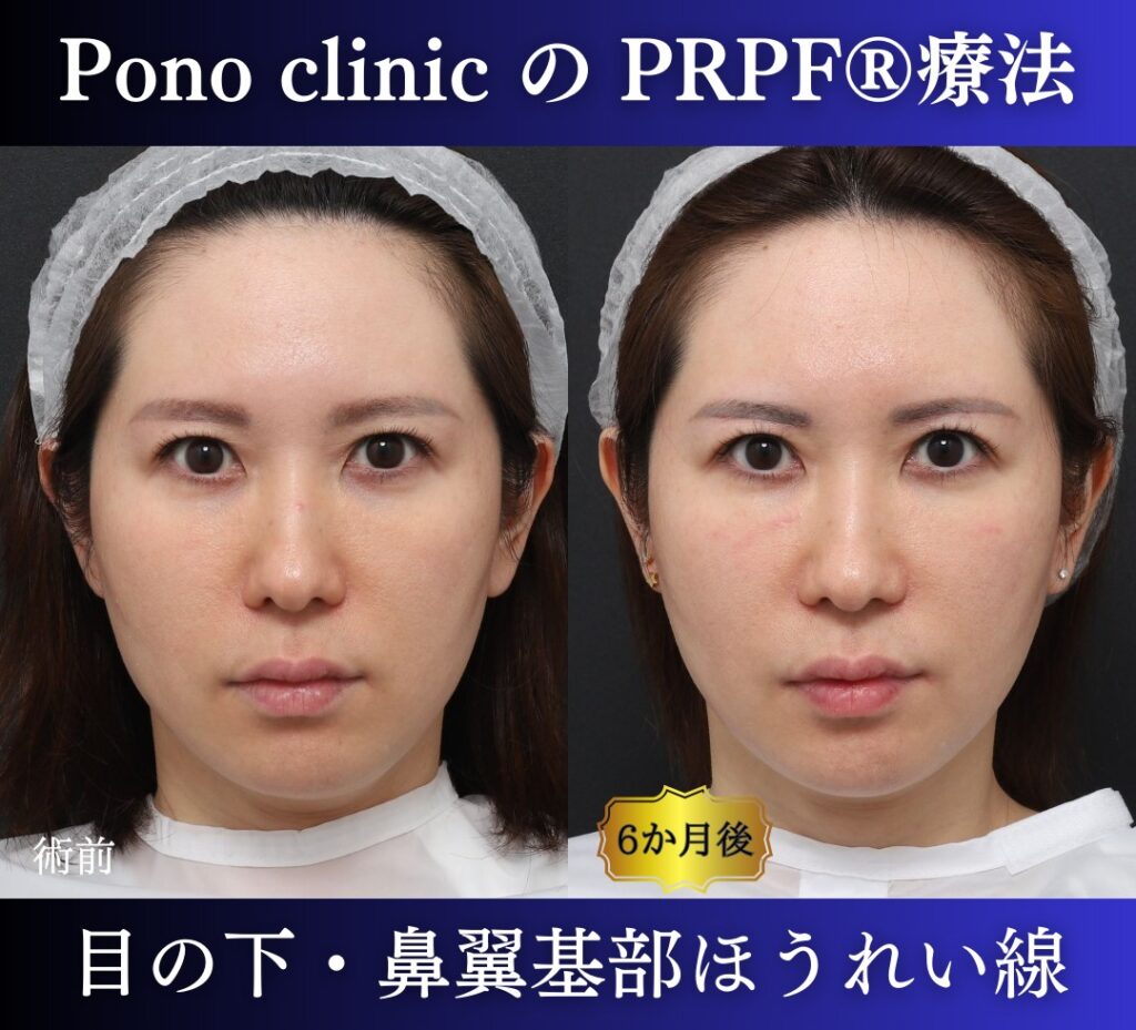 青クマ、法令線、鼻翼基部の凹み、PRPF®療法の症例 (4)