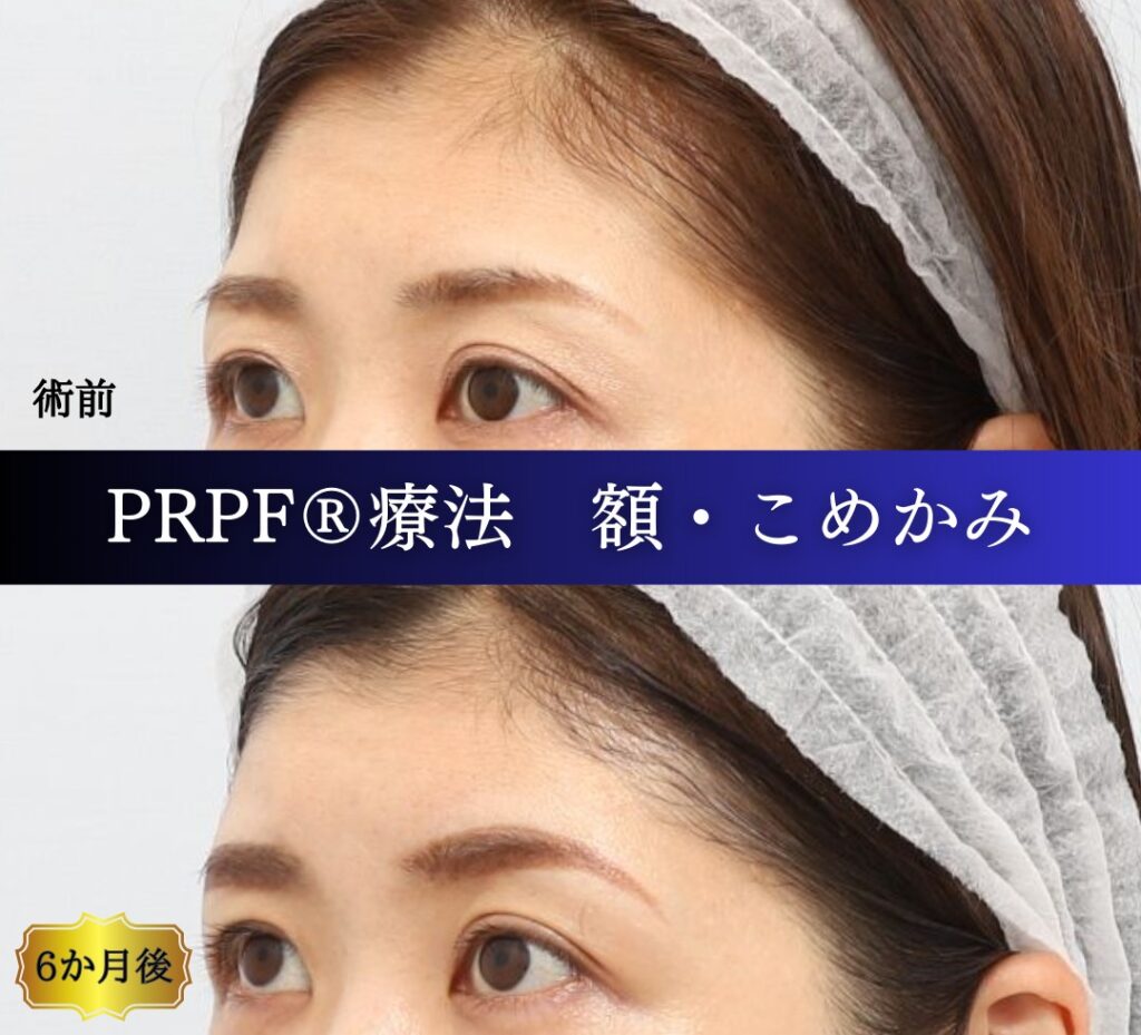 額、こめかみ、PRPF療法の症例 (1)