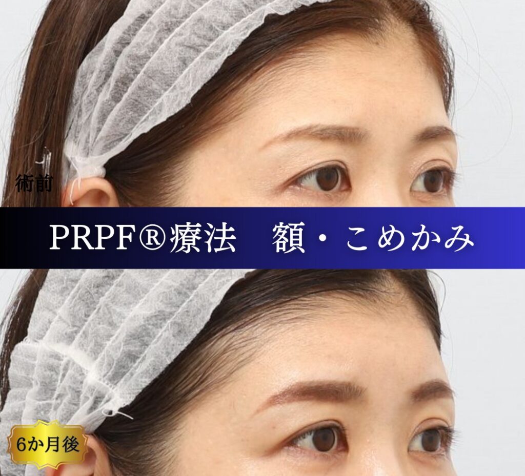額、こめかみ、PRPF療法の症例 (2)