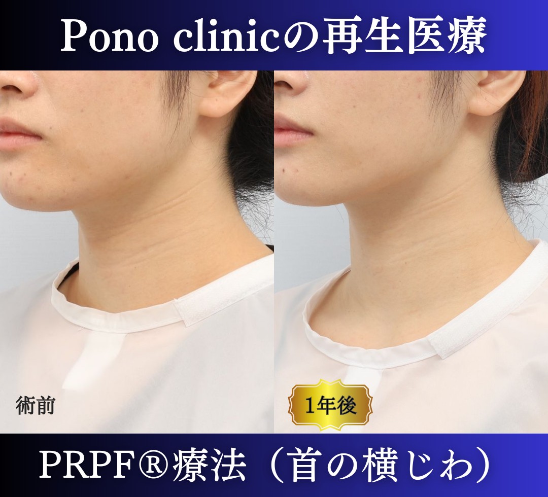 首のしわ、PRPF®療法の症例、20代 (1)