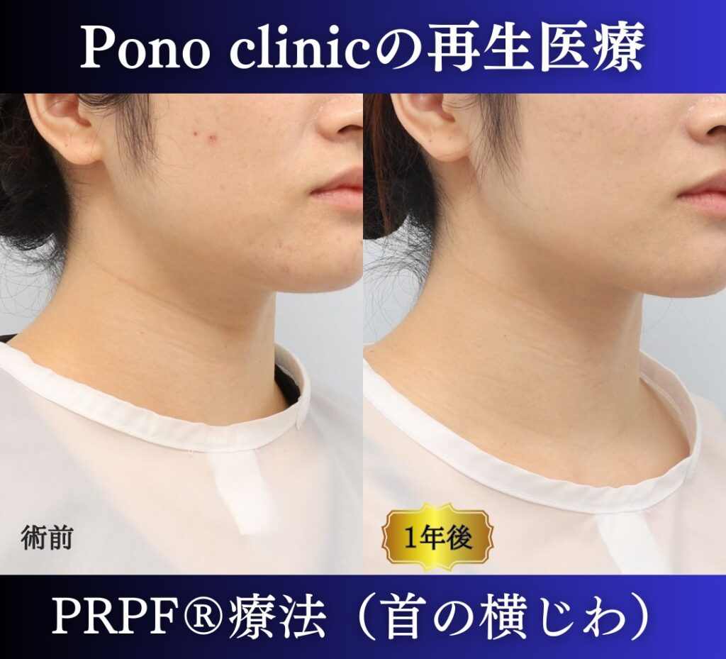 首のしわ、PRPF®療法の症例、20代 (2)