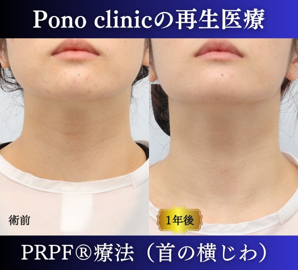 首のしわ、PRPF®療法の症例、20代 (3)