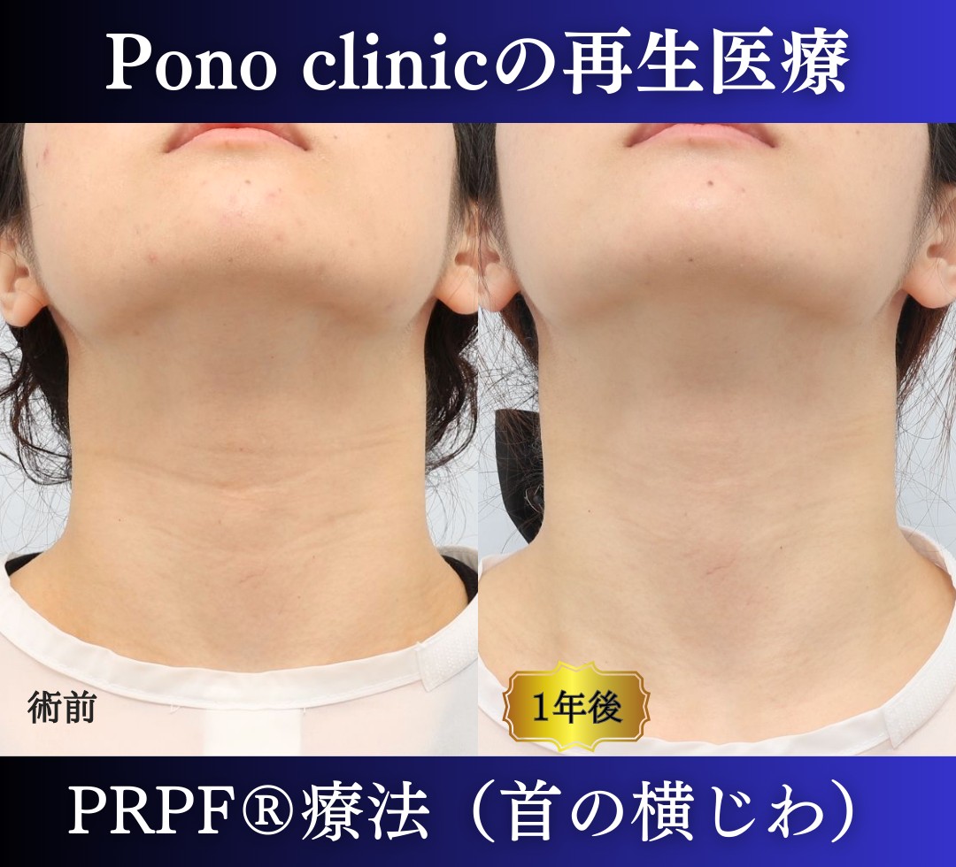 首のしわ、PRPF®療法の症例、20代 (4)