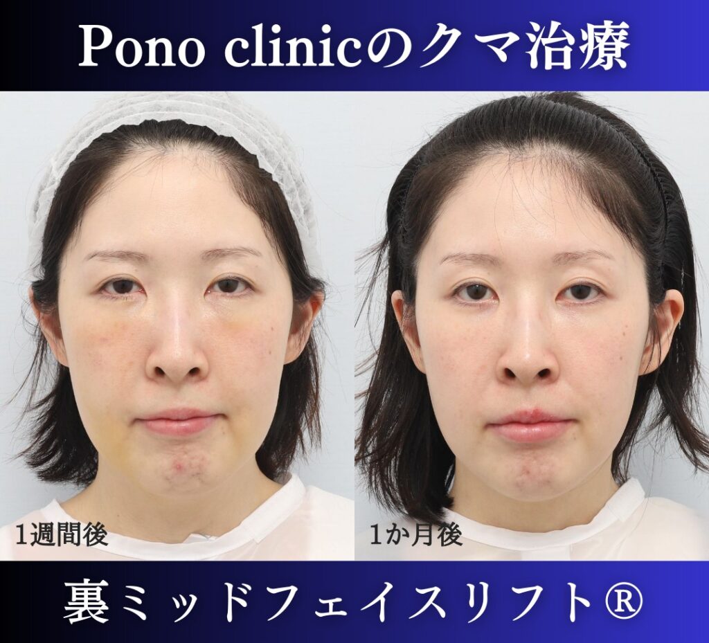 30代女性の症例、目の下のクマ取り (1)