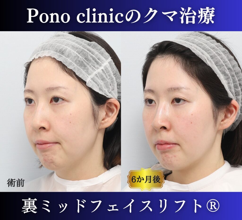 30代女性の症例、目の下のクマ取り (2)