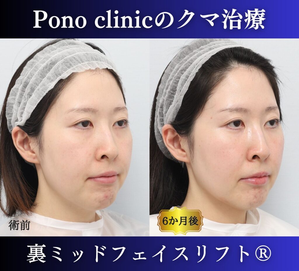 30代女性の症例、目の下のクマ取り (3)