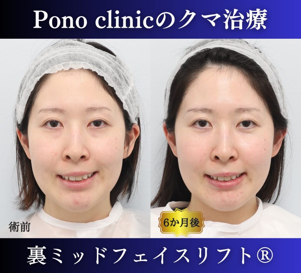 30代女性の症例、目の下のクマ取り (4)