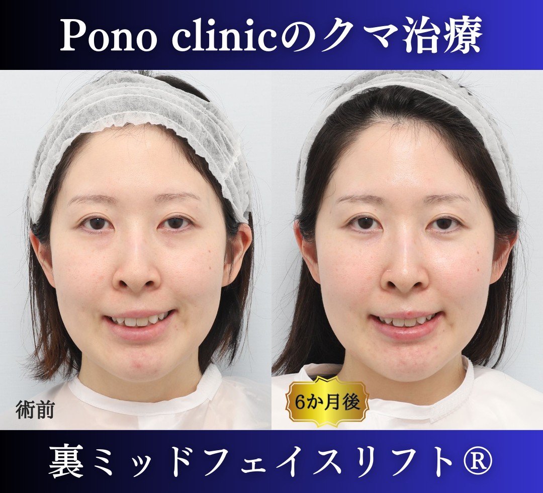 30代女性の症例、目の下のクマ取り (4)