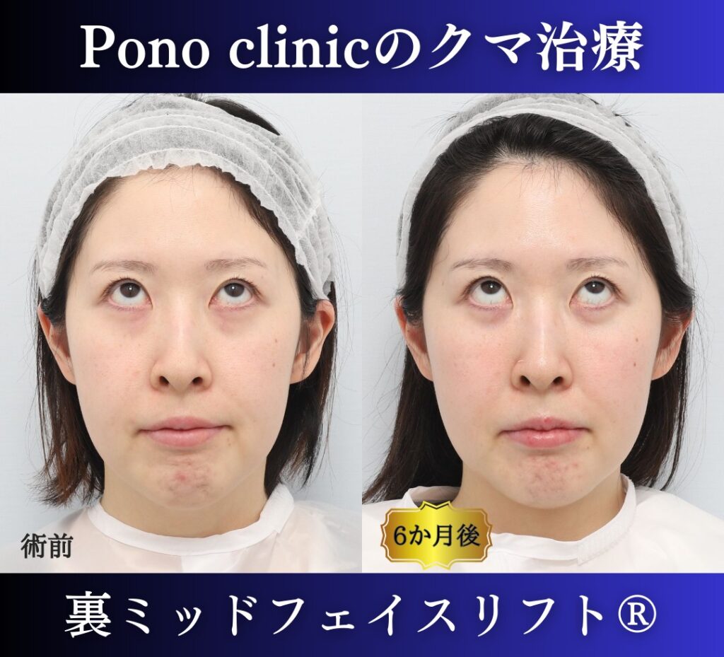 30代女性の症例、目の下のクマ取り (5)