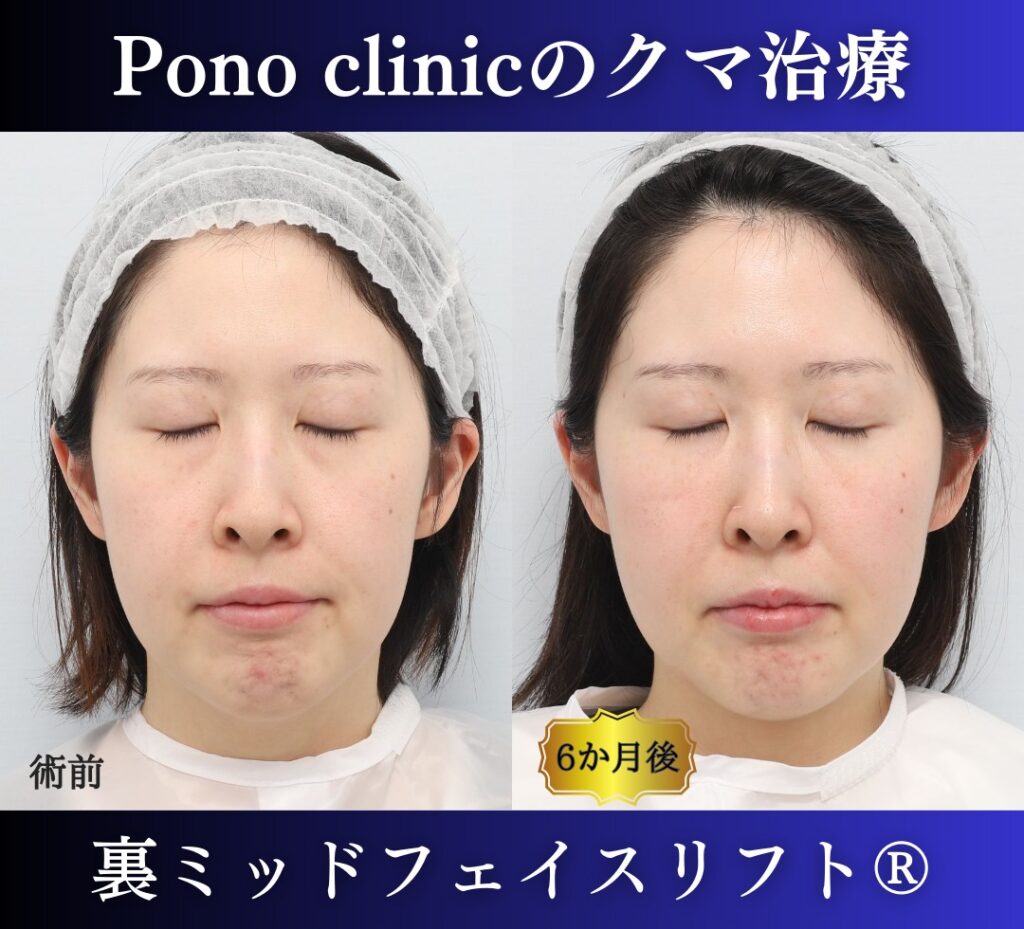 30代女性の症例、目の下のクマ取り (6)