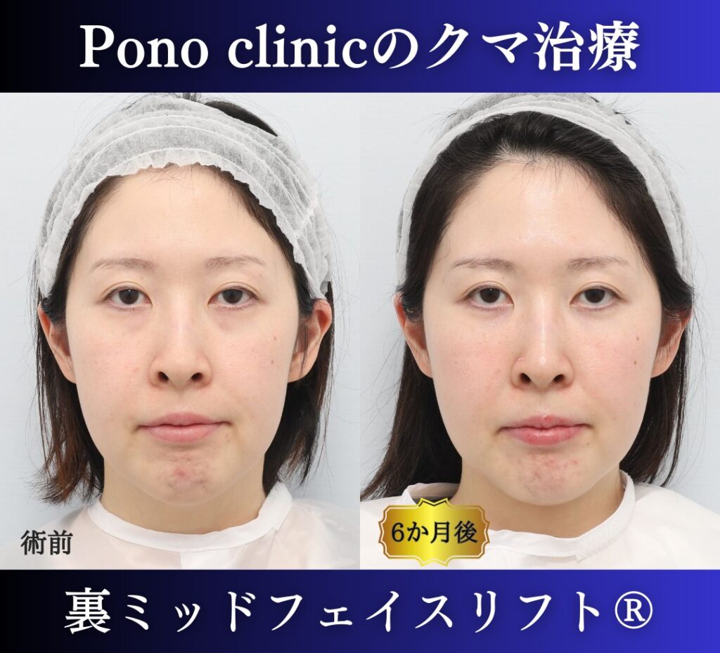 30代女性の症例、目の下のクマ取り (7)