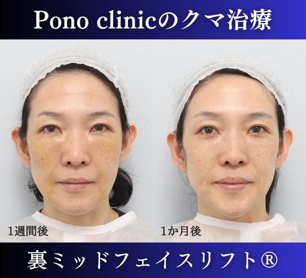 40代女性の症例、目の下のクマ取り (1)