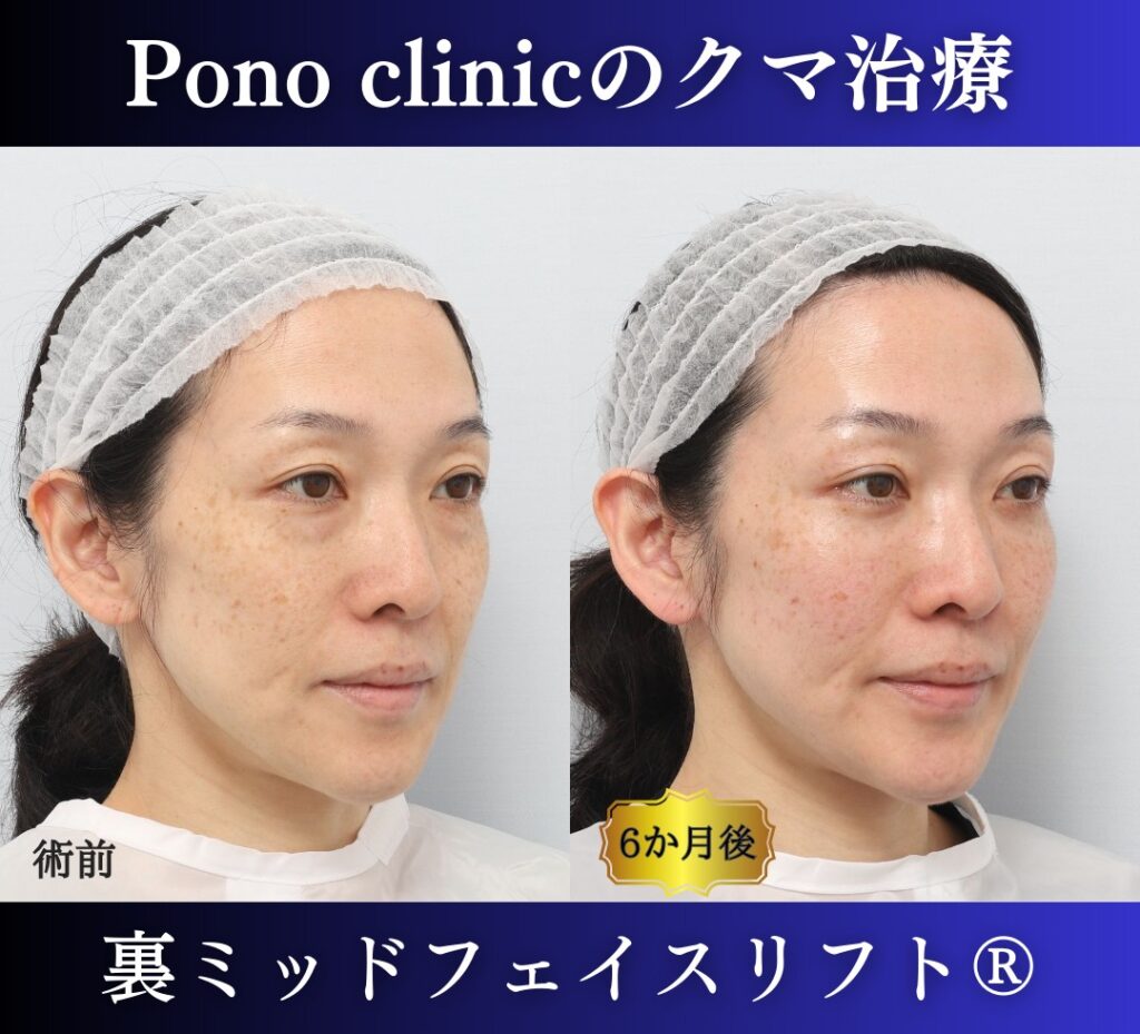 40代女性の症例、目の下のクマ取り (2)